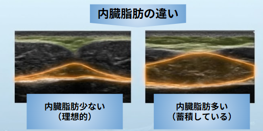 内臓脂肪エコー画像